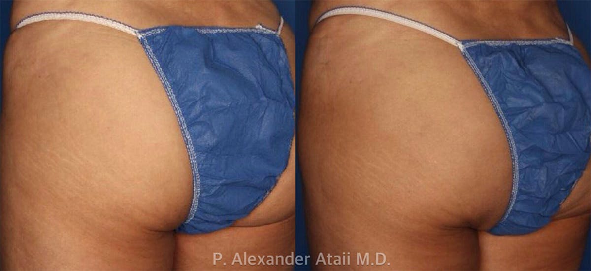 Sculptra Aesthetic Gallery Before & After Gallery - Patient 24560897 - Image 1