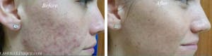 Before and After Acne Treatment in San Diego