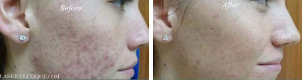Acne Treatment Before & After Gallery - Patient 24560896 - Image 1