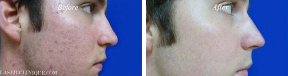 Before and After Acne Treatment in La Jolla