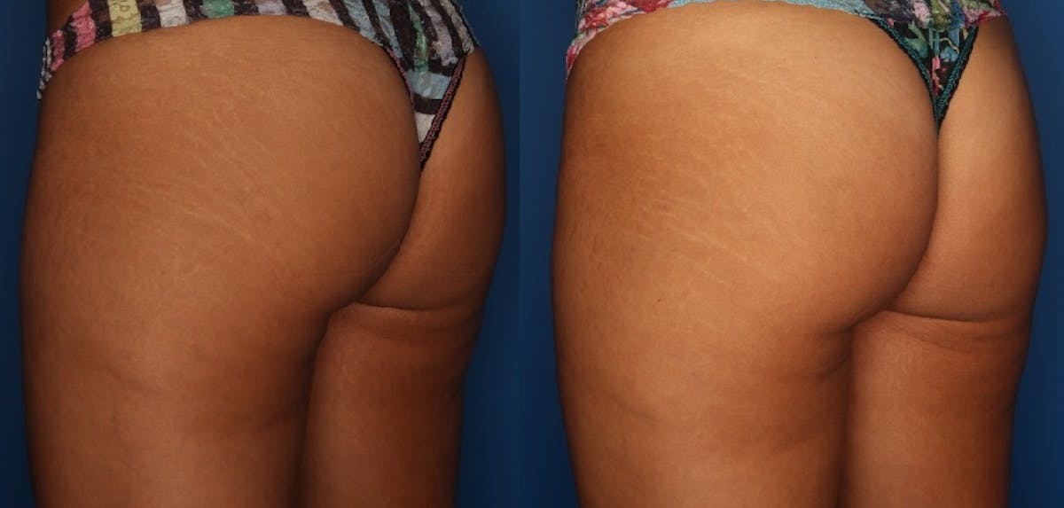Sculptra Aesthetic Before & After Gallery - Patient 24560900 - Image 1