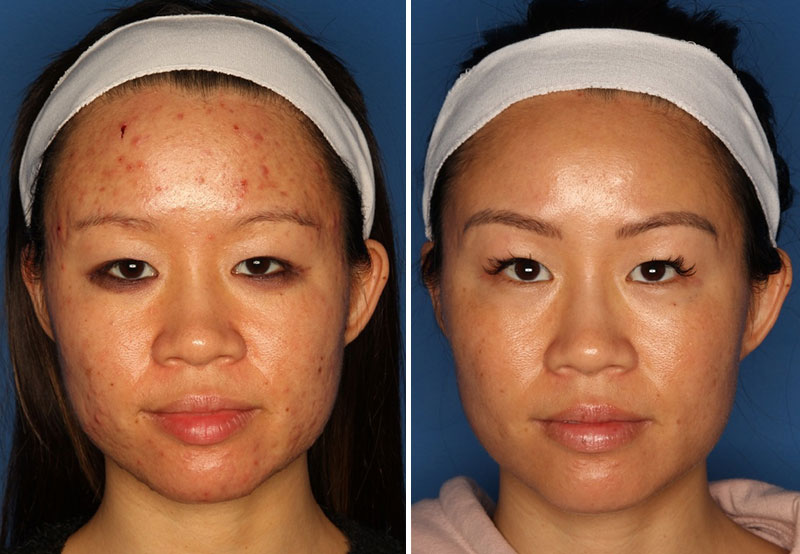 Acne Treatment San Diego Laser Clinique