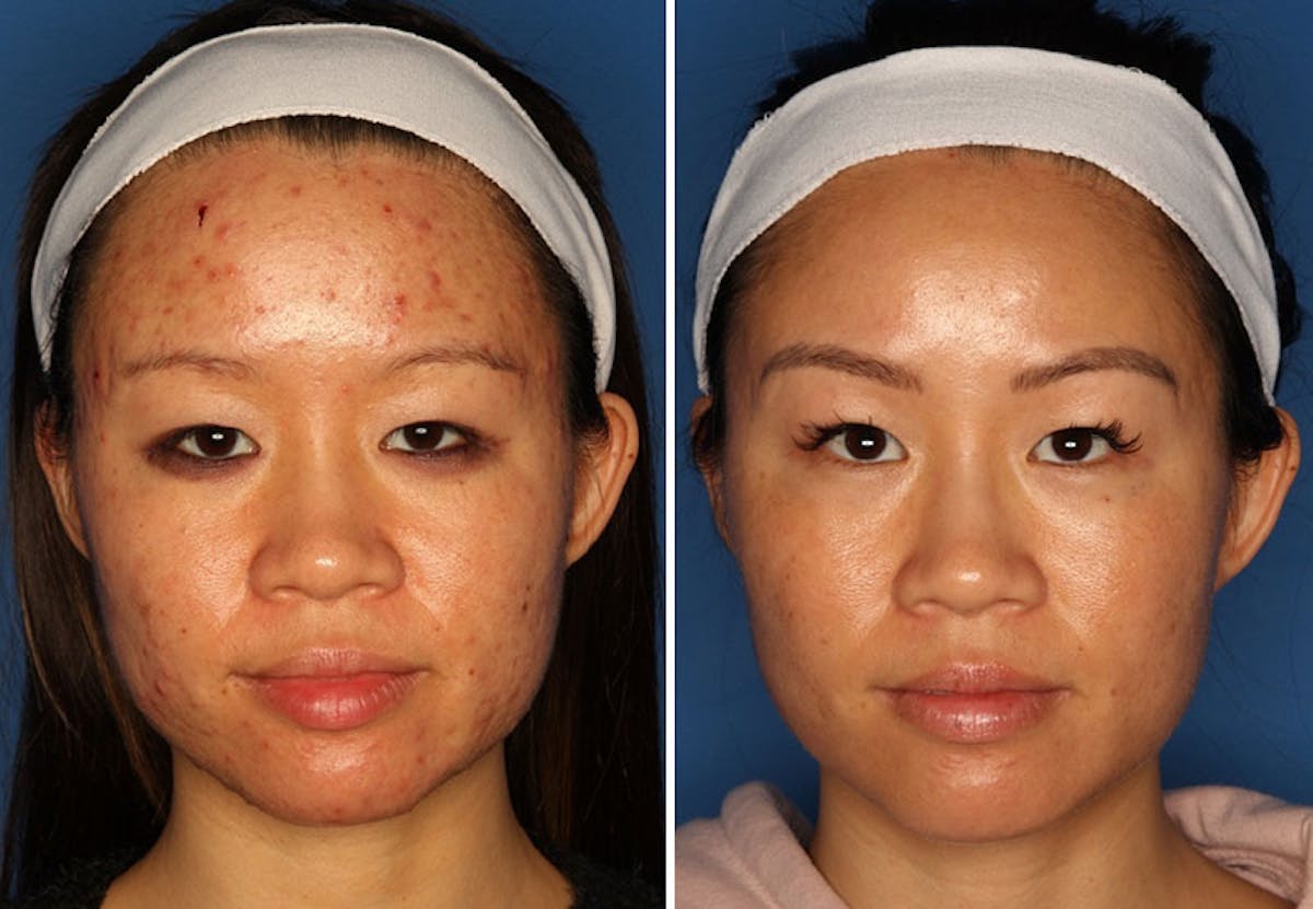 Acne Treatment Before & After Gallery - Patient 24560903 - Image 1