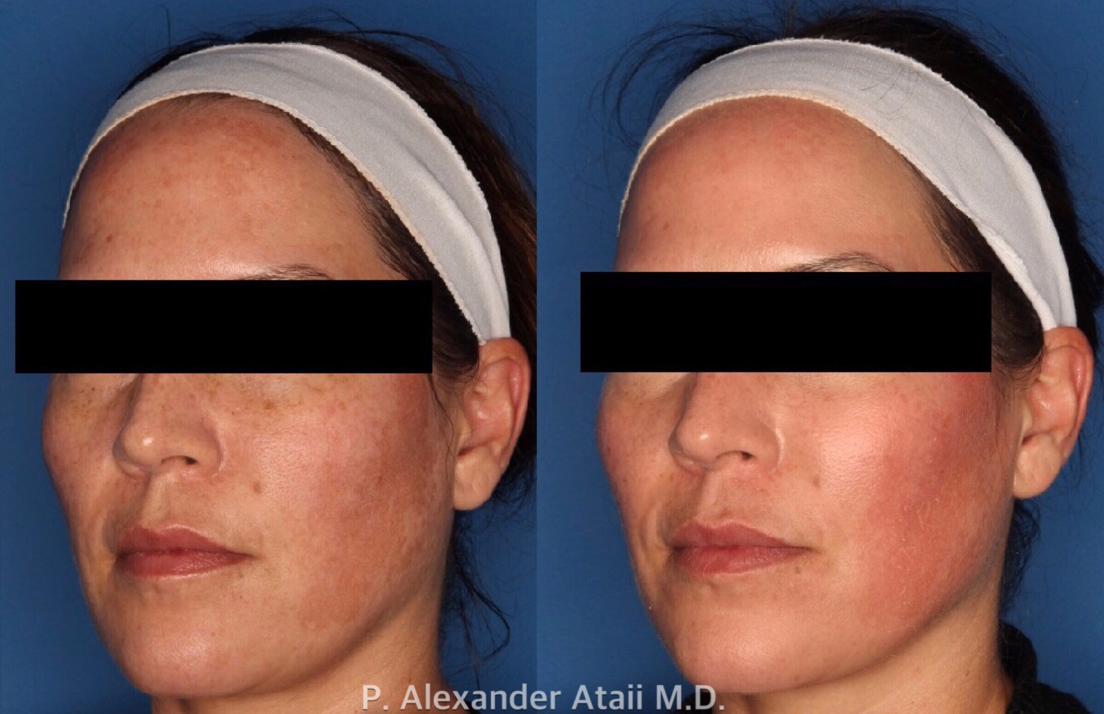 Cosmelan Peel Gallery Before & After Gallery - Patient 24560902 - Image 2