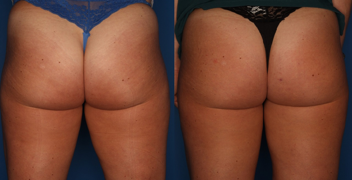 Sculptra Aesthetic Before & After Gallery - Patient 24560904 - Image 1
