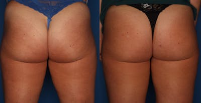 Sculptra Aesthetic Gallery Before & After Gallery - Patient 24560904 - Image 1
