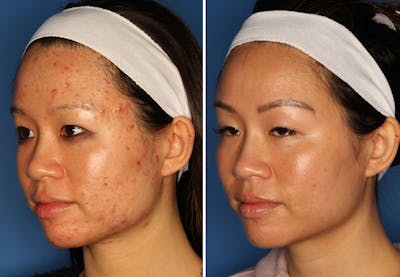 Acne Treatment Gallery Before & After Gallery - Patient 24560903 - Image 2