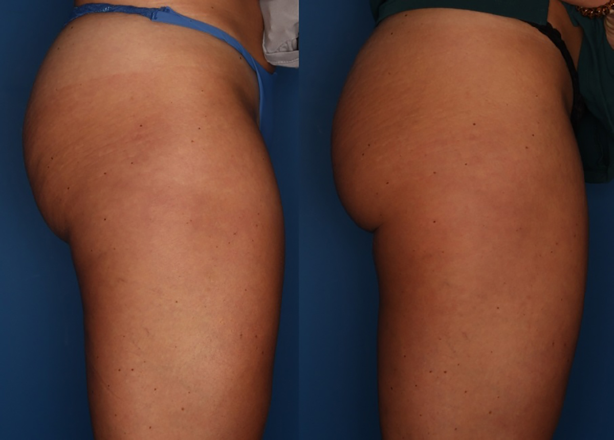 Sculptra Aesthetic Before & After Gallery - Patient 24560904 - Image 2