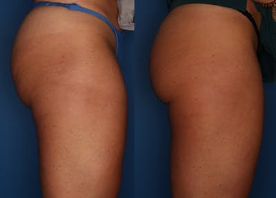 Sculptra Aesthetic Gallery Before & After Gallery - Patient 24560904 - Image 2