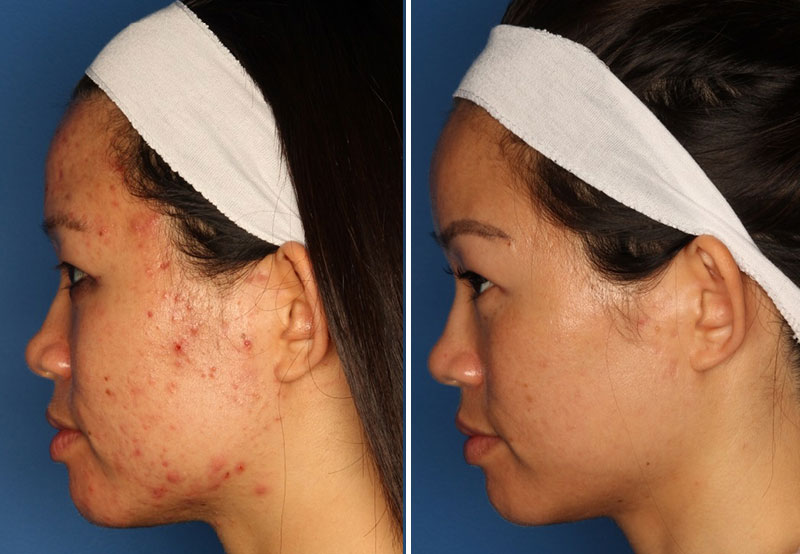 Acne Treatment Gallery Before & After Gallery - Patient 24560903 - Image 3