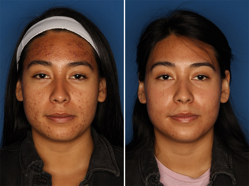 Acne Treatment Before & After Gallery - Patient 24560911 - Image 1