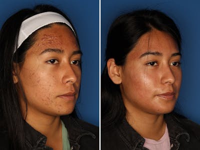 Acne Treatment Gallery Before & After Gallery - Patient 24560911 - Image 2