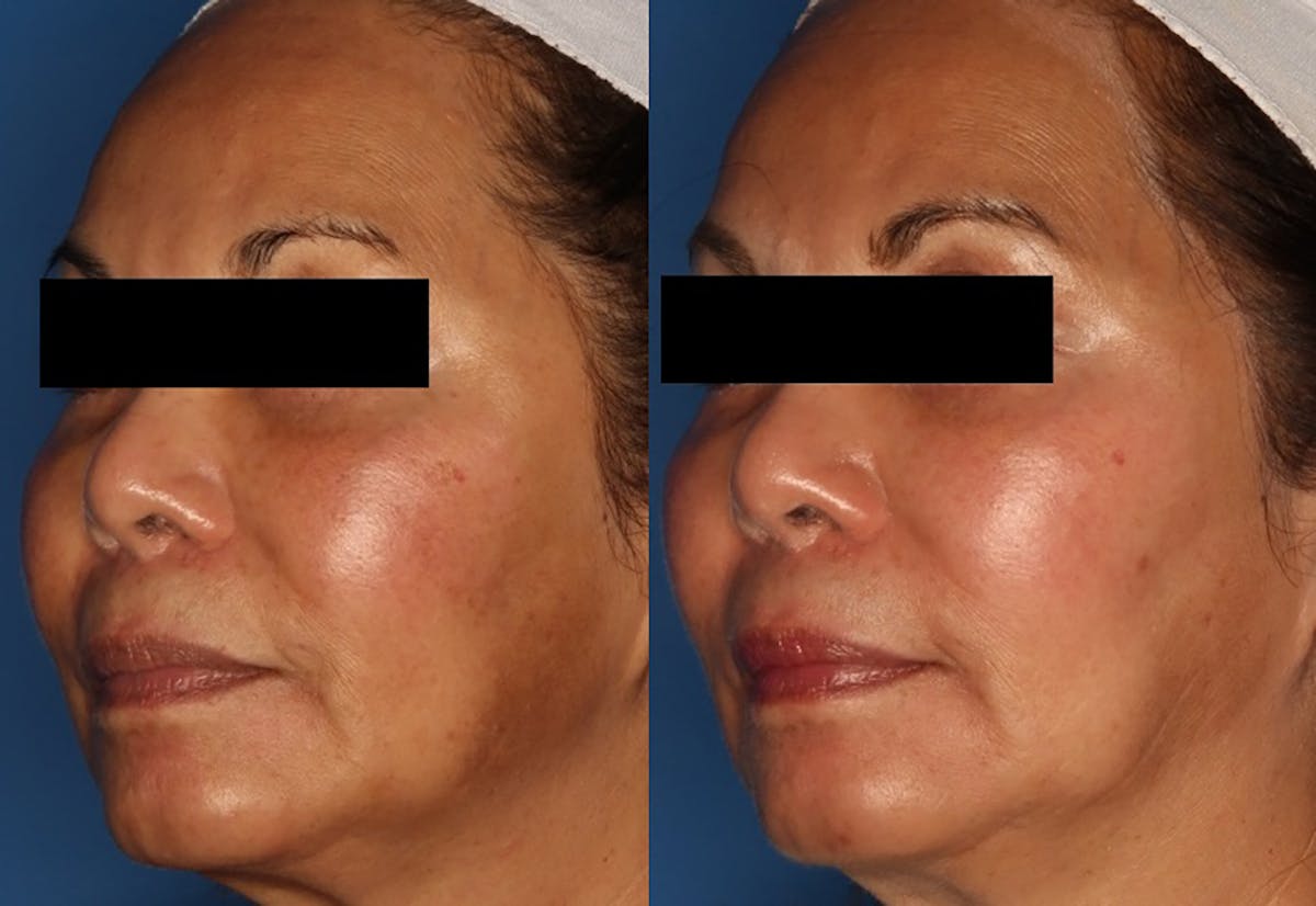 Cosmelan Peel Gallery Before & After Gallery - Patient 24560910 - Image 1