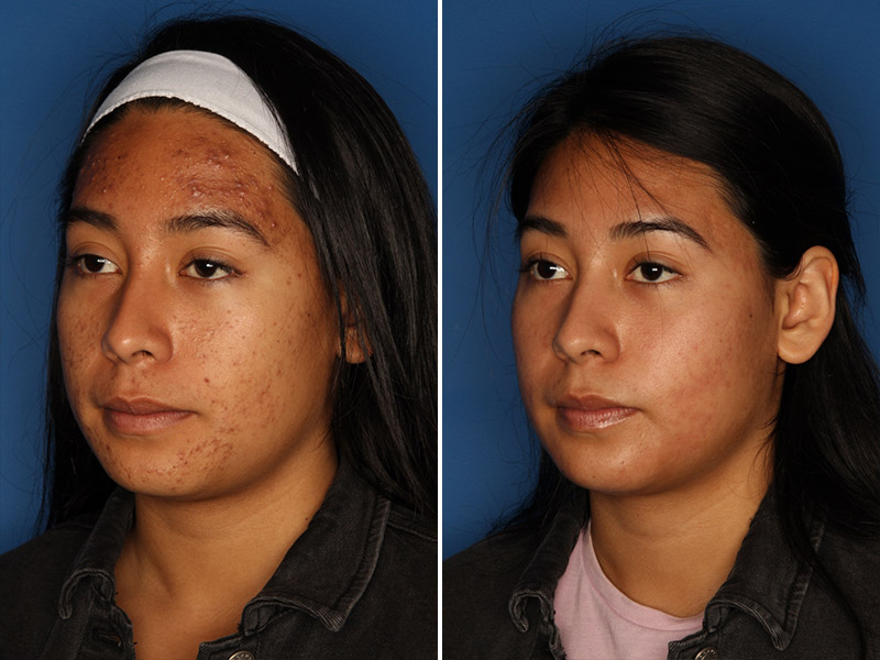 Acne Treatment Gallery Before & After Gallery - Patient 24560911 - Image 3