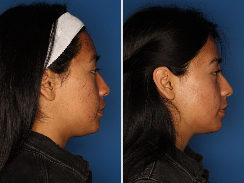 Acne Treatment Gallery Before & After Gallery - Patient 24560911 - Image 4