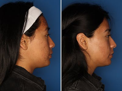 Acne Treatment Gallery Before & After Gallery - Patient 24560911 - Image 4