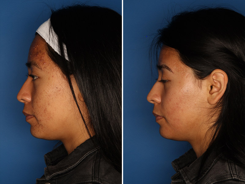 Acne Treatment Gallery Before & After Gallery - Patient 24560911 - Image 5