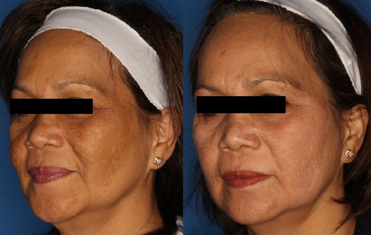 Cosmelan Peel Gallery Before & After Gallery - Patient 24560926 - Image 1