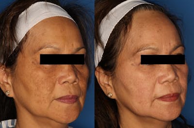 Cosmelan Peel Gallery Before & After Gallery - Patient 24560926 - Image 2