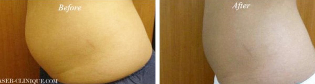 Fat & Cellulite Treatment / Mesoslim Gallery Before & After Gallery - Patient 24560927 - Image 1