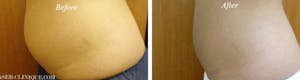 San Diego Cellulite Treatment Before and After