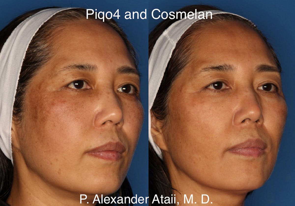Cosmelan Peel Gallery Before & After Gallery - Patient 24560939 - Image 1