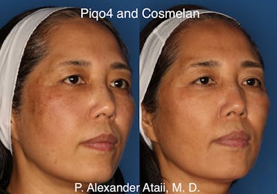 Cosmelan Peel Gallery Before & After Gallery - Patient 24560939 - Image 1