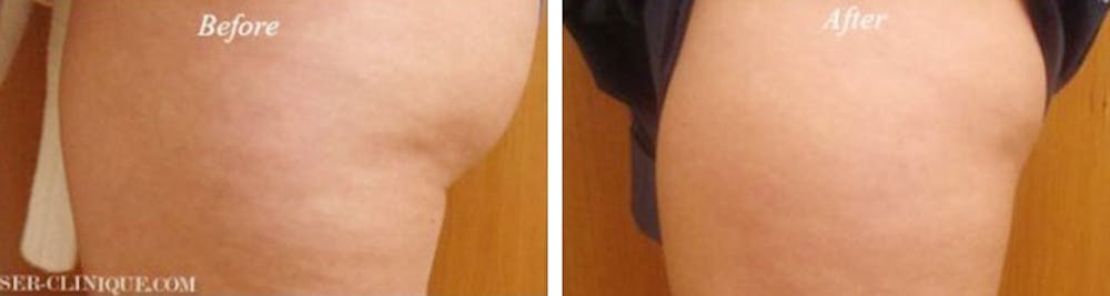La Jolla Cellulite Treatment Before and After
