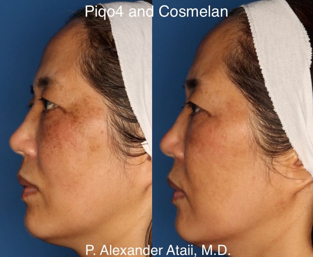 Cosmelan Peel Before & After Gallery - Patient 24560939 - Image 3