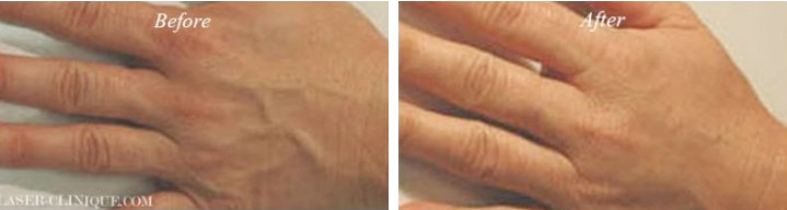 Hand Rejuvenation Before & After Gallery - Patient 24560943 - Image 1