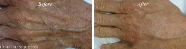 Hand Rejuvenation Before & After Gallery - Patient 24560944 - Image 1