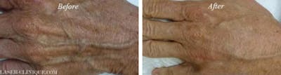 Hand Rejuvenation Before & After Gallery - Patient 24560944 - Image 1