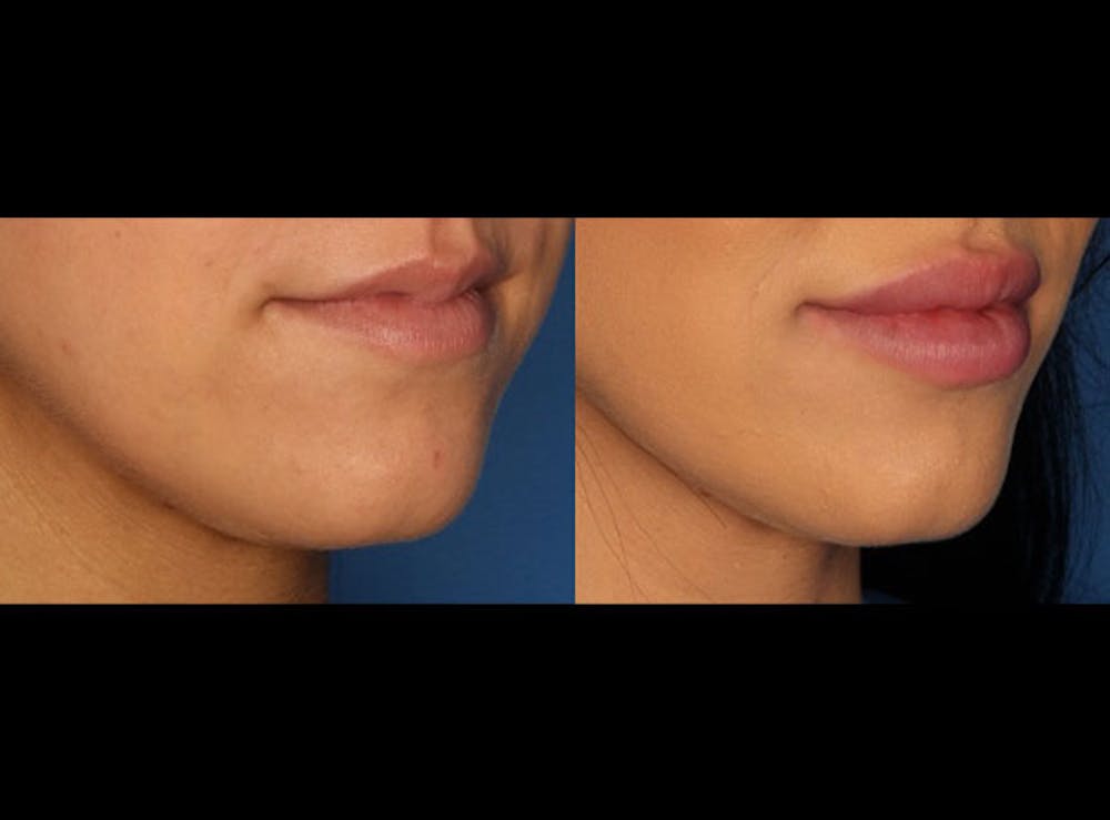 Lip Augmentation Before & After Gallery - Patient 24560959 - Image 1