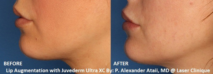 Lip Fillers Before & After Gallery - Patient 24560962 - Image 1
