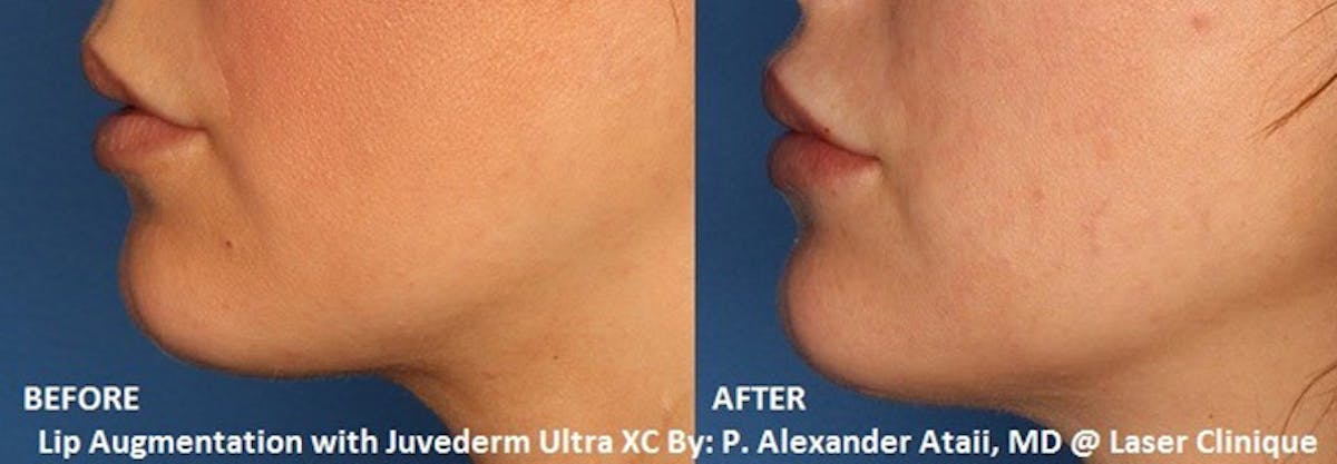 Lip Augmentation Before & After Gallery - Patient 24560962 - Image 1