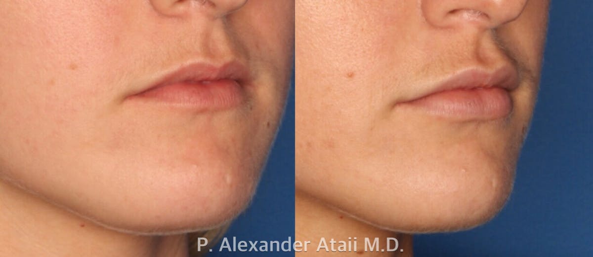 Lip Augmentation Gallery Before & After Gallery - Patient 24560968 - Image 1