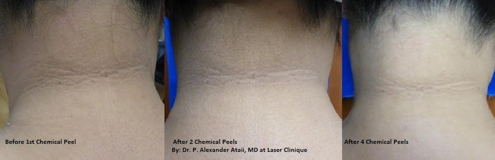 Before and AFter of Chemical Peels in San Diego