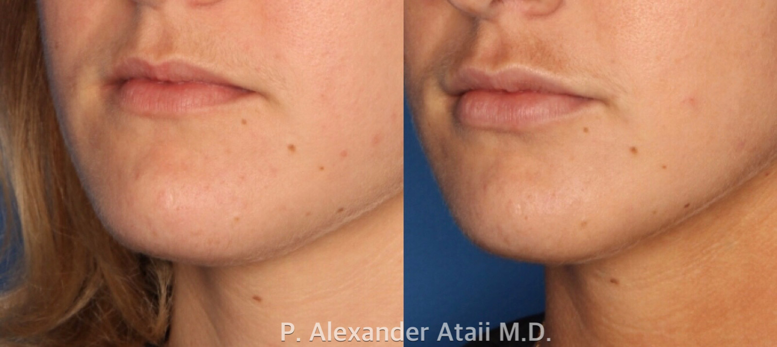 Lip Augmentation Before & After Gallery - Patient 24560968 - Image 2