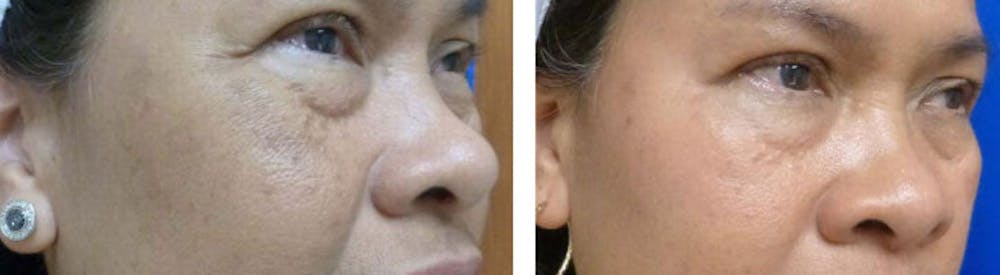 San Diego Chemical Peel Results