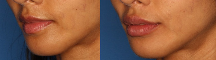 Lip Fillers Before & After Gallery - Patient 24560972 - Image 1