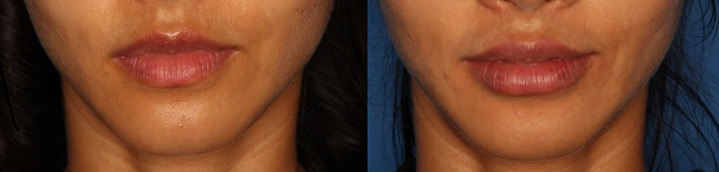 Lip Augmentation Gallery Before & After Gallery - Patient 24560972 - Image 2