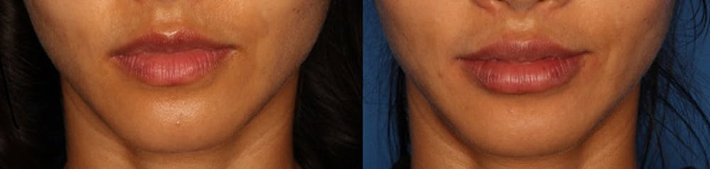 Lip Augmentation Before & After Gallery - Patient 24560972 - Image 2