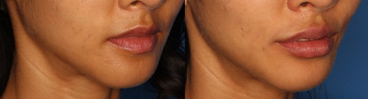 Lip Augmentation Gallery Before & After Gallery - Patient 24560972 - Image 3