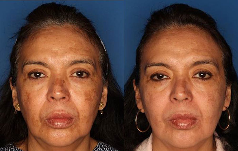 Medical Grade Chemical Peels Gallery - Patient 24560973 - Image 1