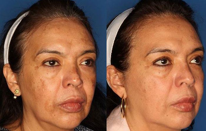 Medical Grade Chemical Peels Before & After Gallery - Patient 24560973 - Image 2