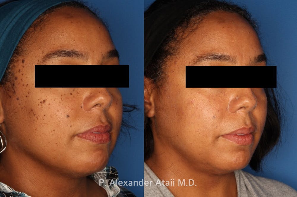 Mole Removal Before & After Gallery - Patient 24560975 - Image 1