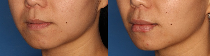 Lip Augmentation Gallery Before & After Gallery - Patient 24560974 - Image 2