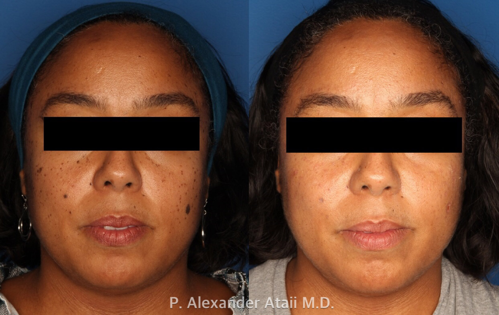 Mole Removal Gallery Before & After Gallery - Patient 24560975 - Image 2