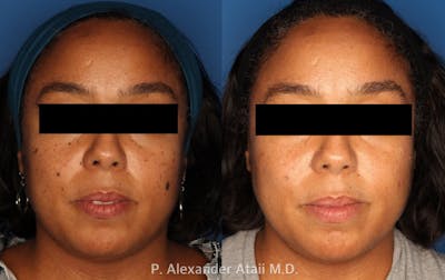Mole Removal Gallery Before & After Gallery - Patient 24560975 - Image 2
