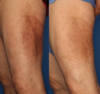 Medical Grade Chemical Peels Before & After Gallery - Patient 24560976 - Image 1